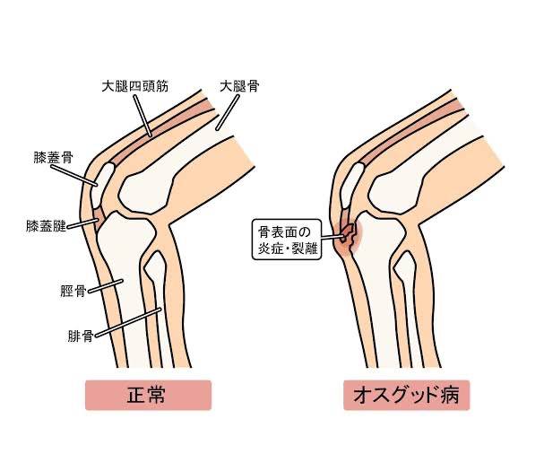 相模大野で「オスグット」にお悩みなら！「さがみおおの整骨院」にお任せください