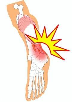 【相模大野でアキレス腱炎にお悩みの方へ】整骨院選びで迷ったら「さがみおおの整骨院」がおすすめ！